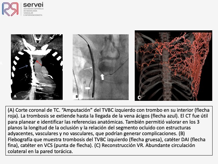 Recanalizacion troncos venosos centrales 04