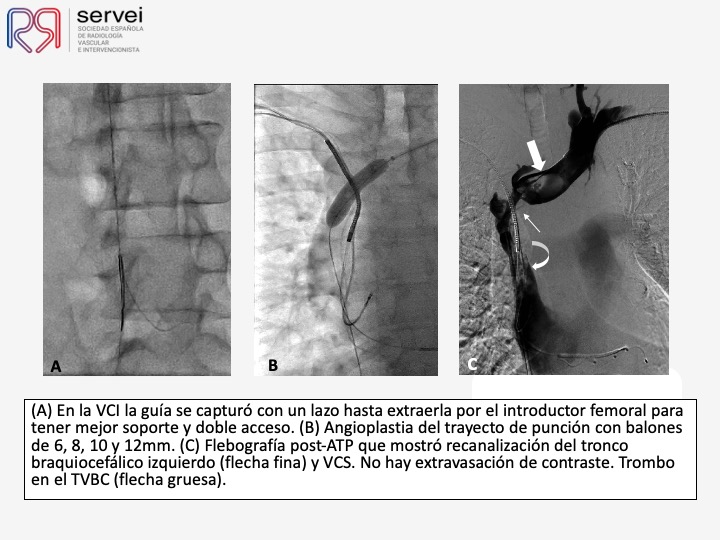 Recanalizacion troncos venosos centrales 07