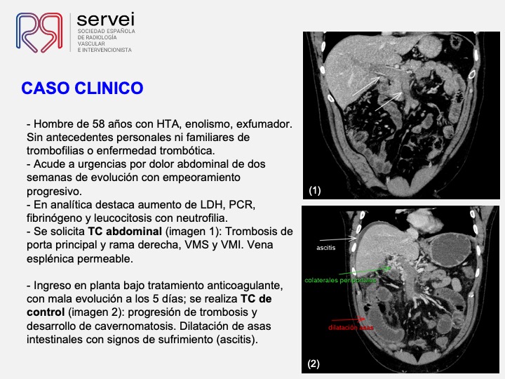 Isquemia mesenterica venosa 02