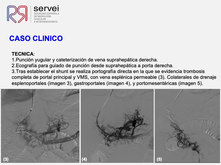 Isquemia mesenterica venosa 04