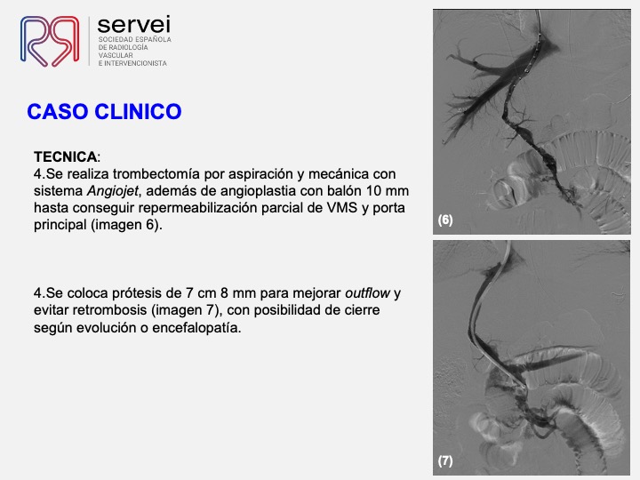 Isquemia mesenterica venosa 05