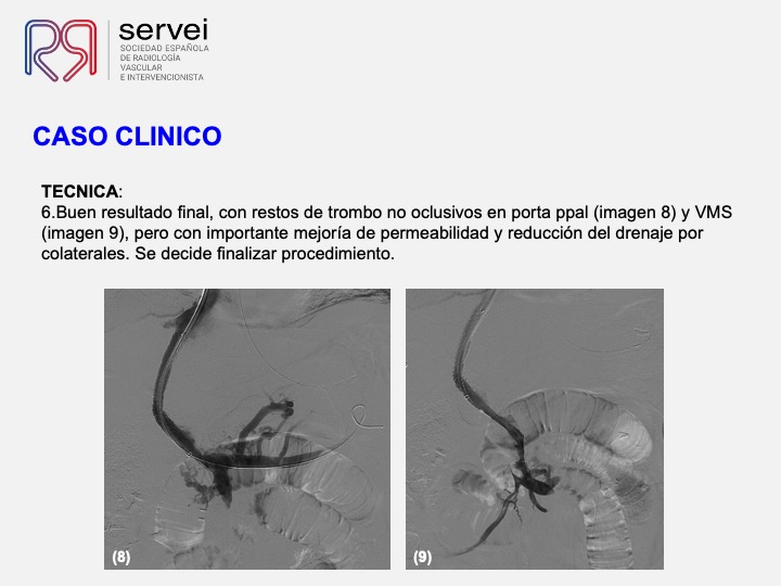 Isquemia mesenterica venosa 06