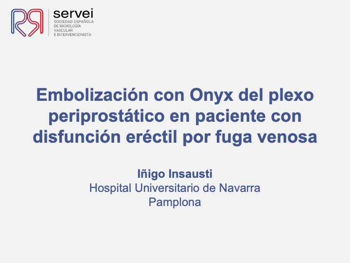 Embolizacion onyx plexo periprostatico disfuncion erectil 01