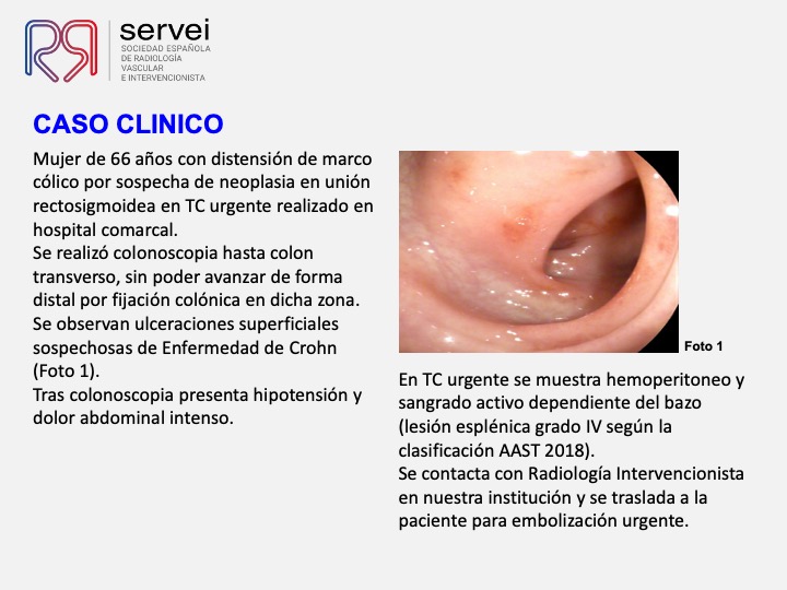 Traumatismo esplenico postcolonoscopia 02