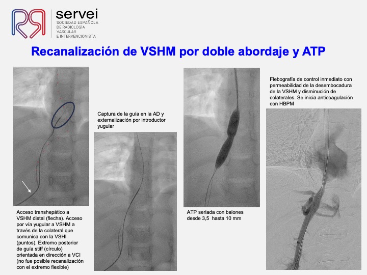 Sindrome Budd Chiari infantil 05