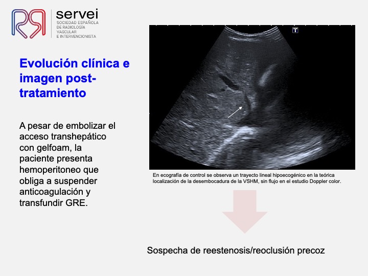Sindrome Budd Chiari infantil 06