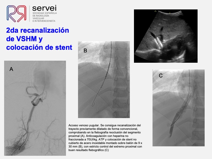 Sindrome Budd Chiari infantil 07