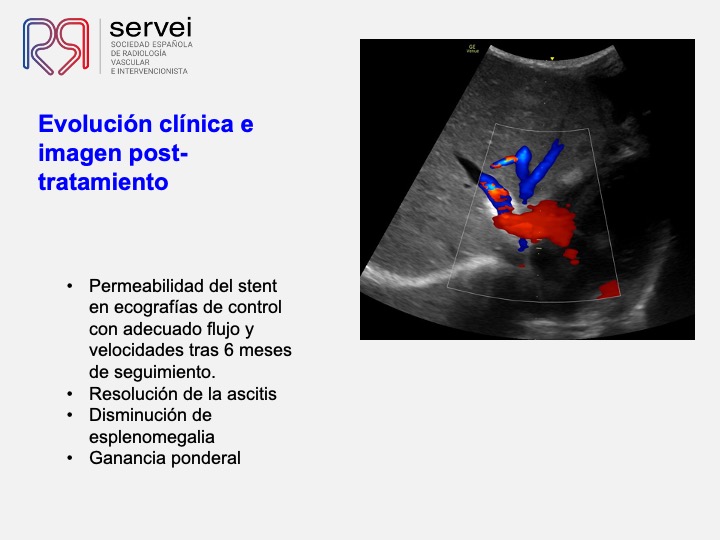 Sindrome Budd Chiari infantil 08