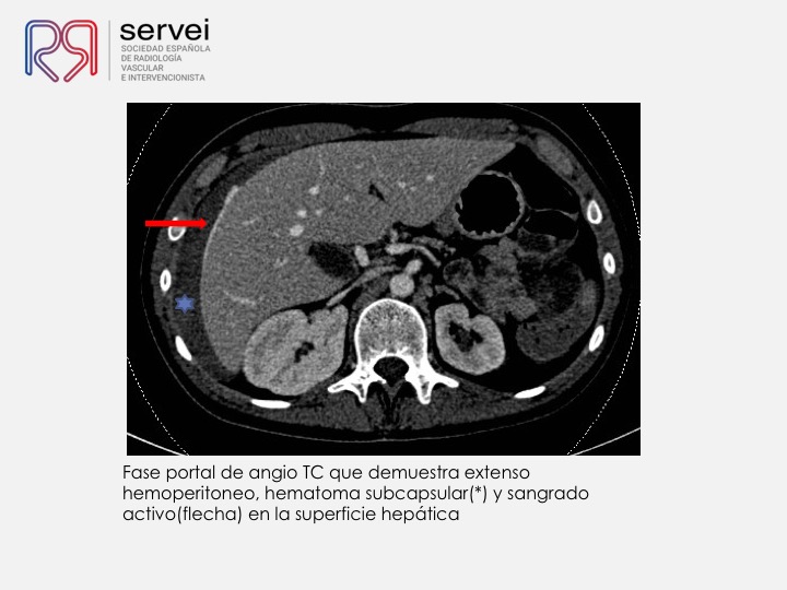 03 Hemorragia hepatica postbiopsia-embolizacion con Onyx