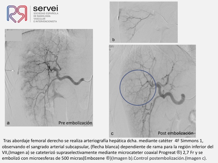04 Hemorragia hepatica postbiopsia-embolizacion con Onyx