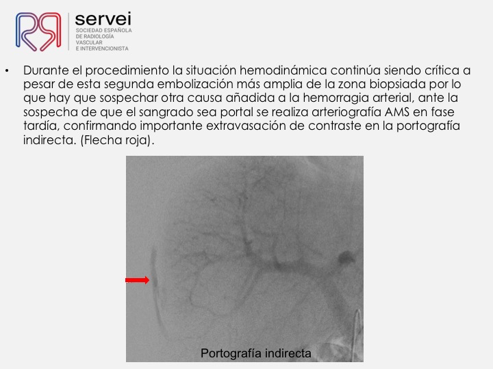 06 Hemorragia hepatica postbiopsia-embolizacion con Onyx