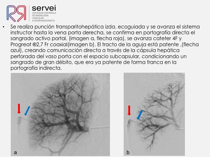 07 Hemorragia hepatica postbiopsia-embolizacion con Onyx