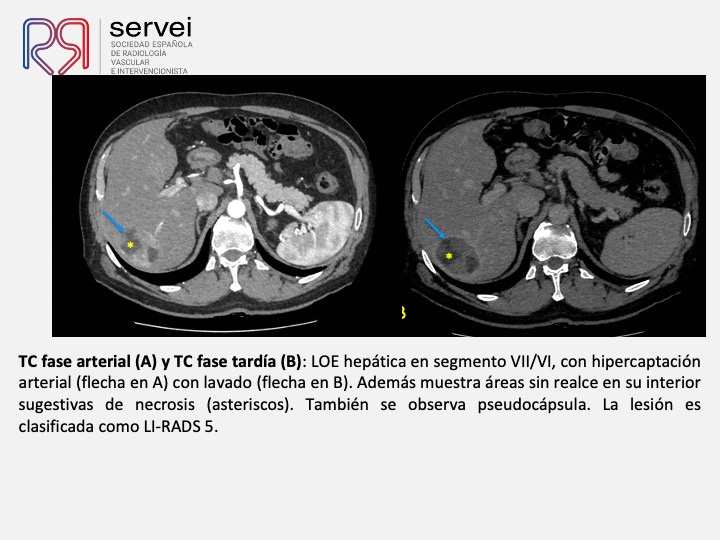 Radioembolizacion hepatocarcinoma estadio inicial 03