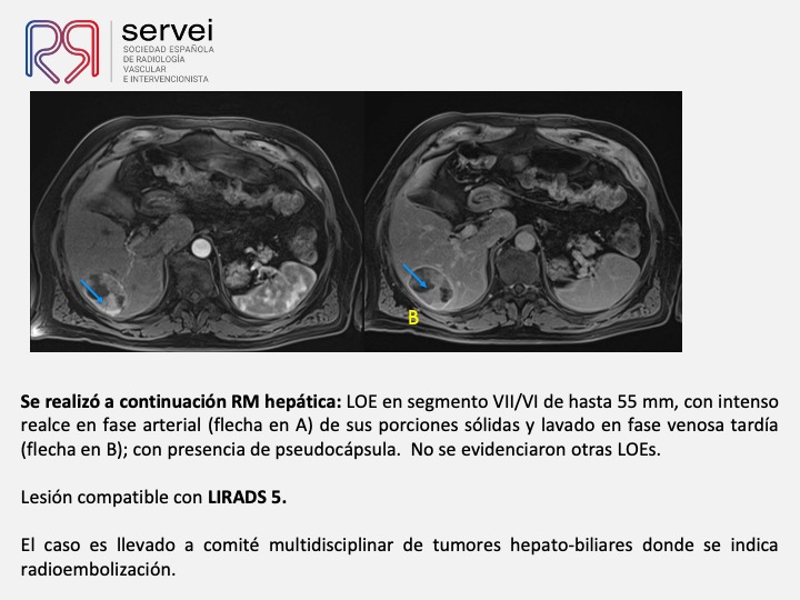 Radioembolizacion hepatocarcinoma estadio inicial 04