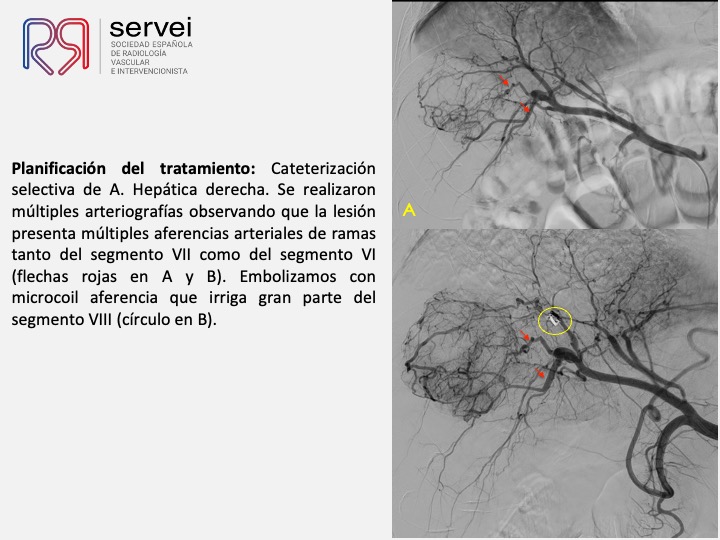 Radioembolizacion hepatocarcinoma estadio inicial 06