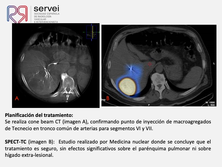 Radioembolizacion hepatocarcinoma estadio inicial 07