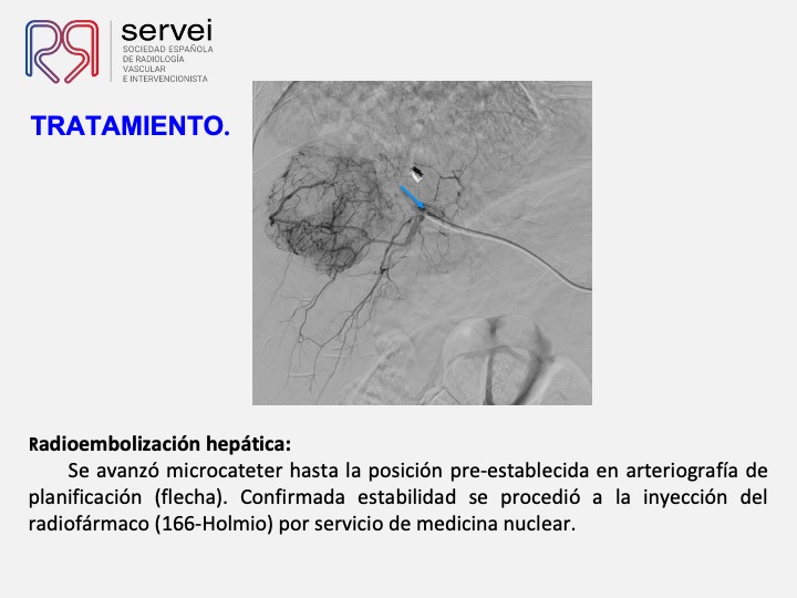 Radioembolizacion hepatocarcinoma estadio inicial 08
