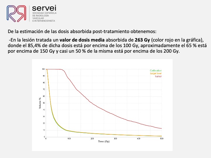 Radioembolizacion hepatocarcinoma estadio inicial 09