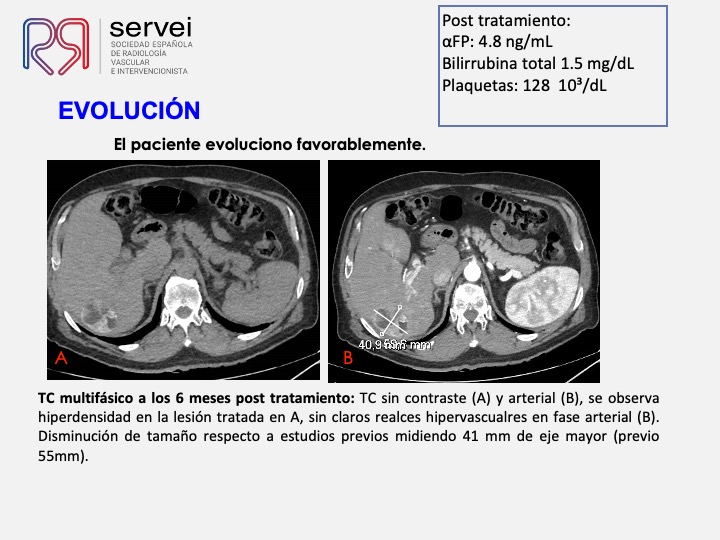 Radioembolizacion hepatocarcinoma estadio inicial 10