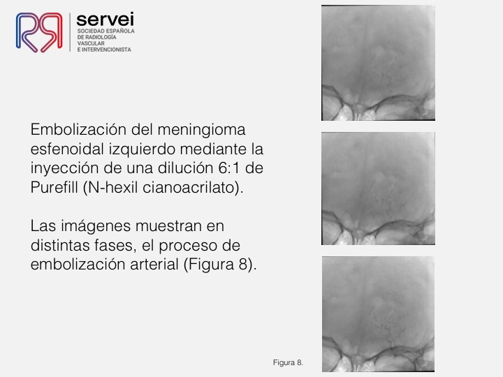 Embolizacion meningioma09
