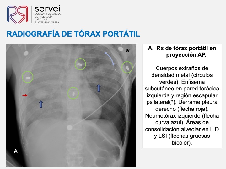 Pseudoaneurisma pulnonar herida arma fuego 03