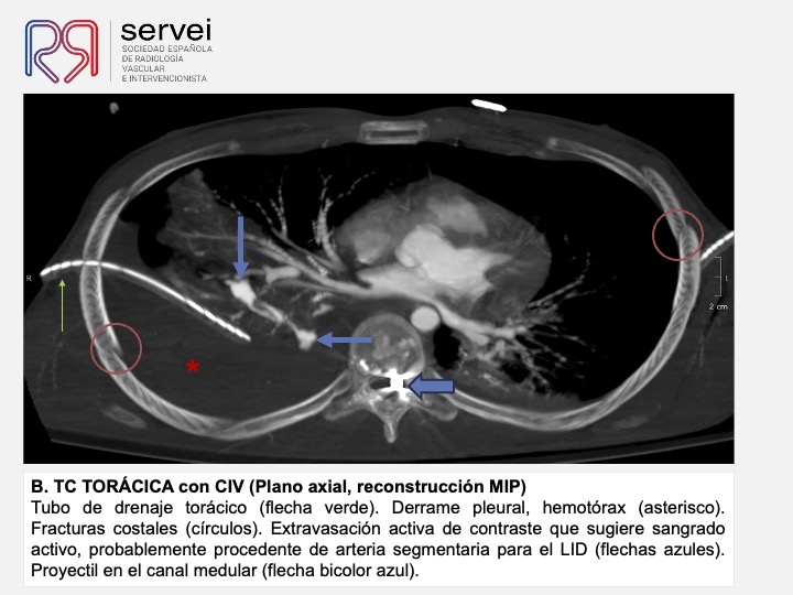 Pseudoaneurisma pulnonar herida arma fuego 04