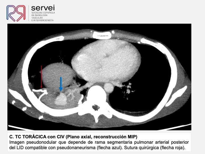 Pseudoaneurisma pulnonar herida arma fuego 06