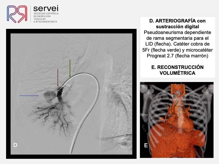 Pseudoaneurisma pulnonar herida arma fuego 07