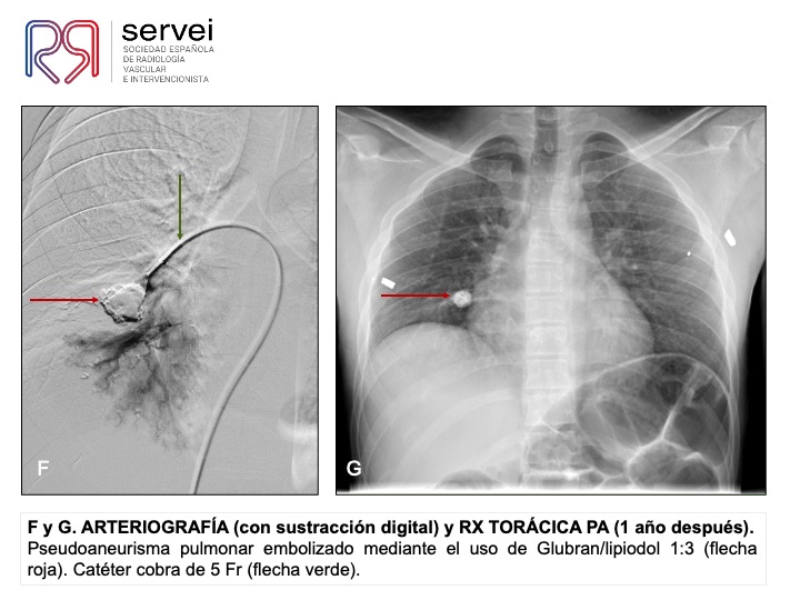 Pseudoaneurisma pulnonar herida arma fuego 08