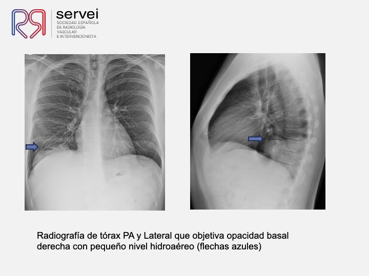 Embolizacion por infeccion pulmonar 03