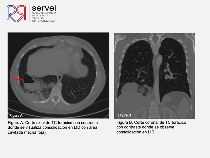 Embolizacion por infeccion pulmonar 04
