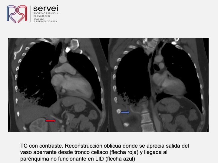 Embolizacion por infeccion pulmonar 05