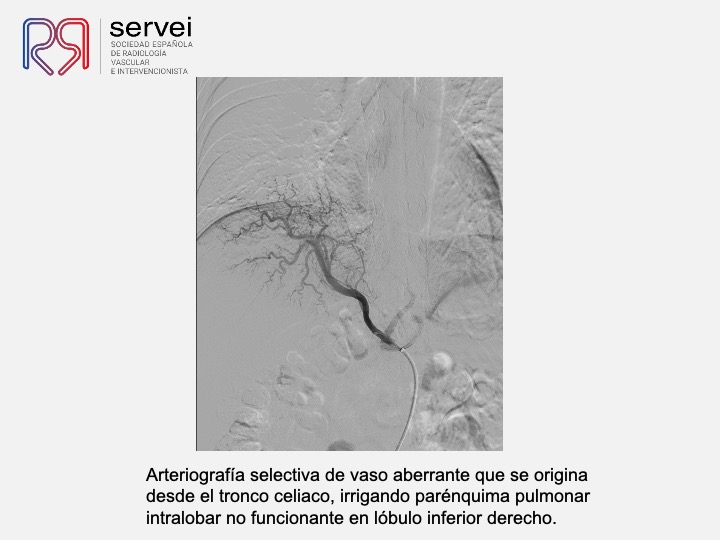 Embolizacion por infeccion pulmonar 07