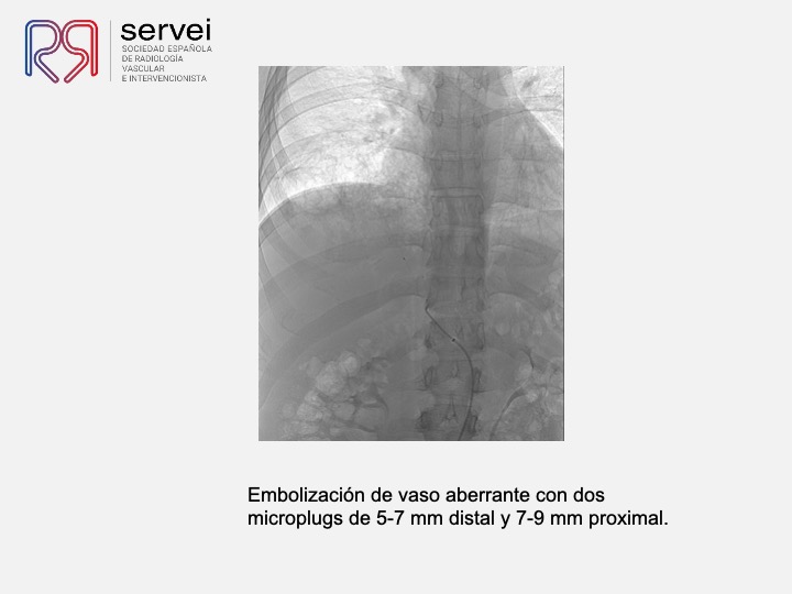 Embolizacion por infeccion pulmonar 08