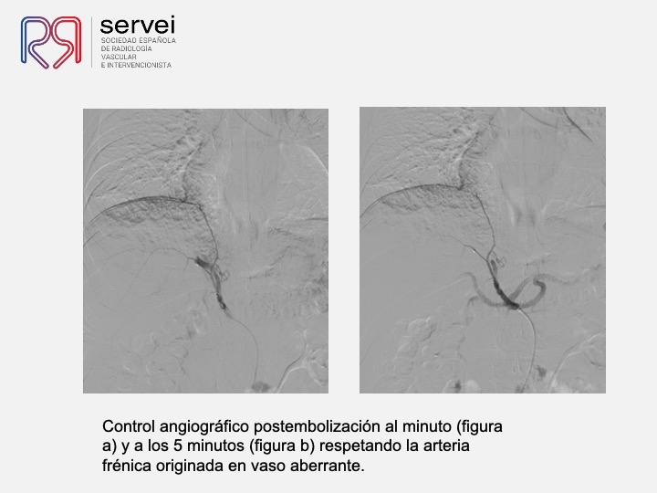 Embolizacion por infeccion pulmonar 09
