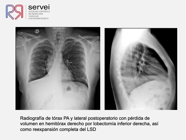 Embolizacion por infeccion pulmonar 11