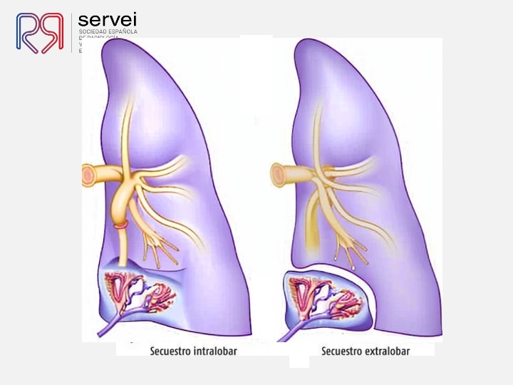 Embolizacion por infeccion pulmonar 13