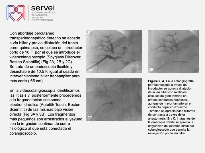 Tratamiento percutaneo litiasis biliar 04