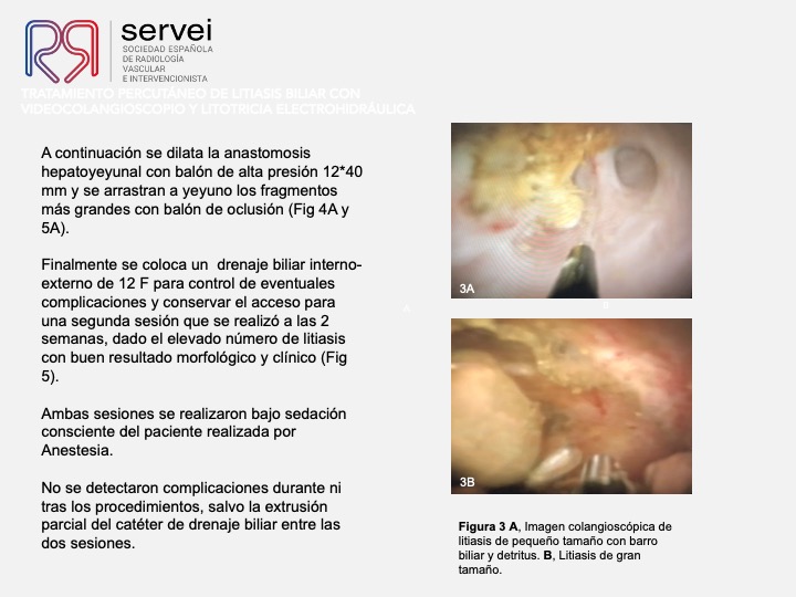 Tratamiento percutaneo litiasis biliar 05