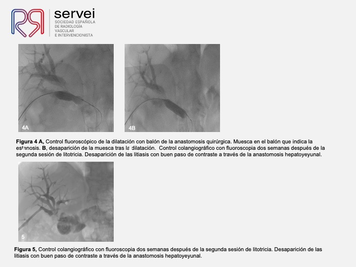 Tratamiento percutaneo litiasis biliar 06