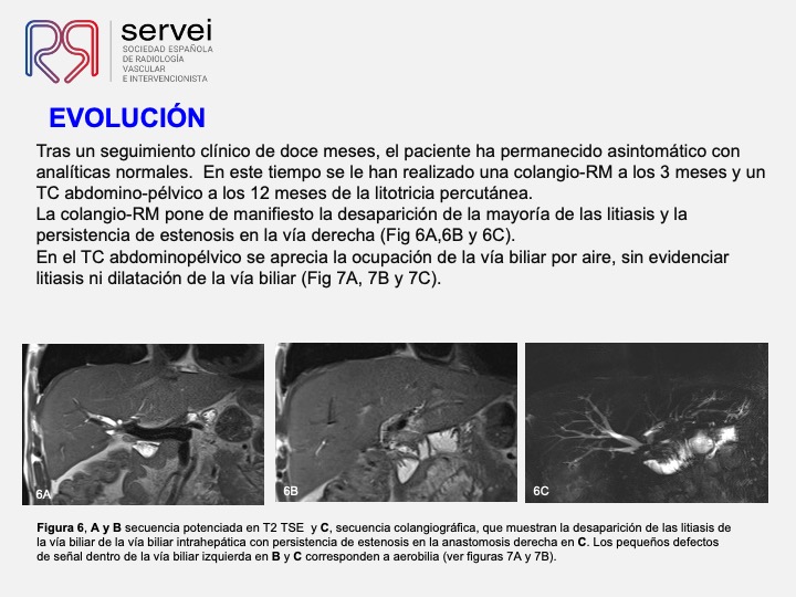 Tratamiento percutaneo litiasis biliar 07