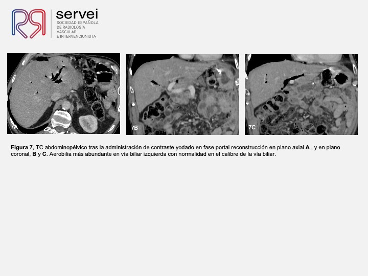 Tratamiento percutaneo litiasis biliar 08