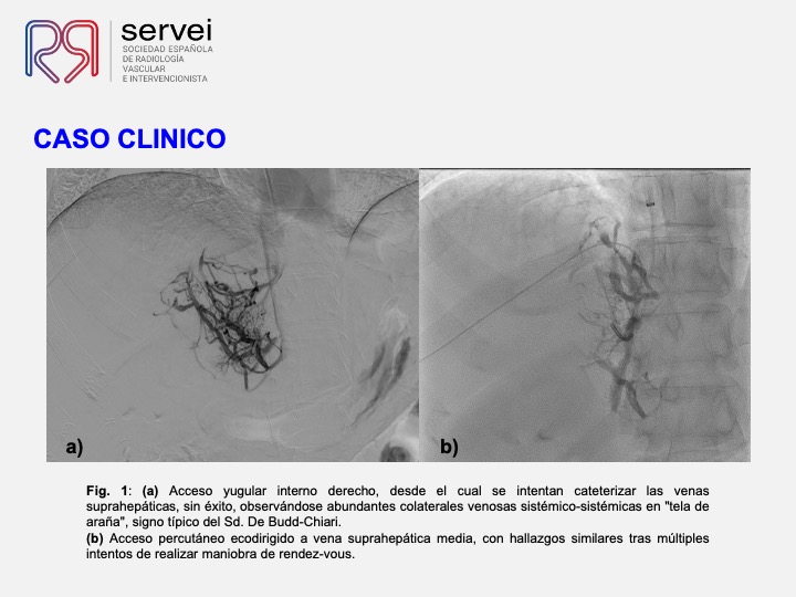 DIPS tecnica gun-sight 03
