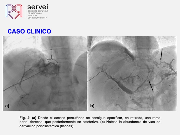 DIPS tecnica gun-sight 04