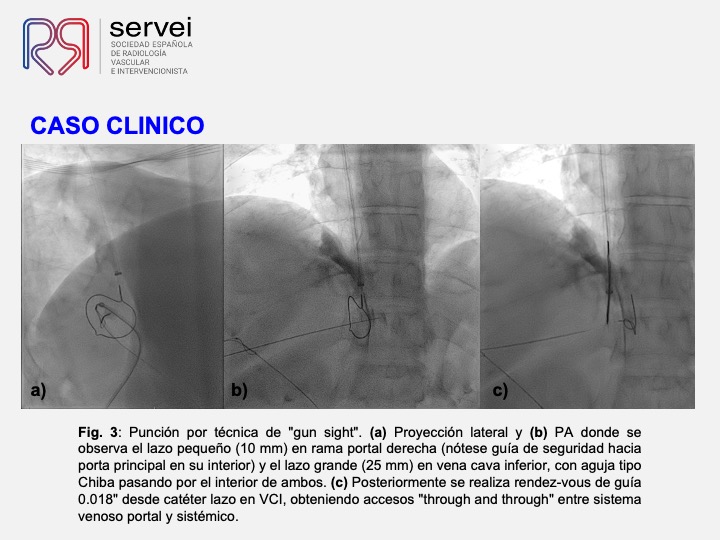 DIPS tecnica gun-sight 05