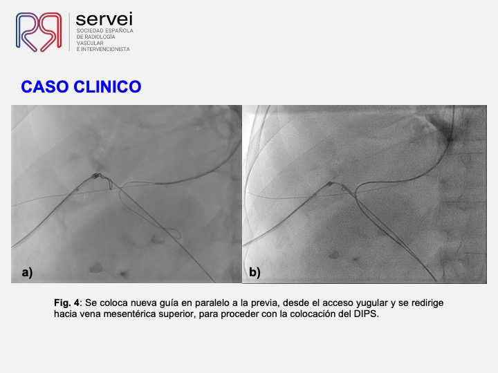 DIPS tecnica gun-sight 06