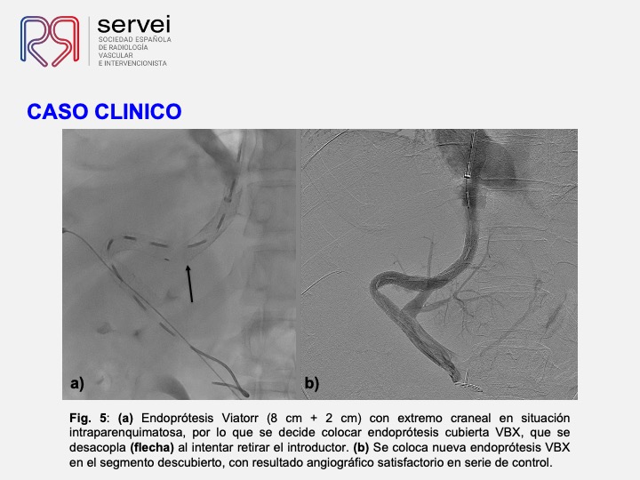 DIPS tecnica gun-sight 07