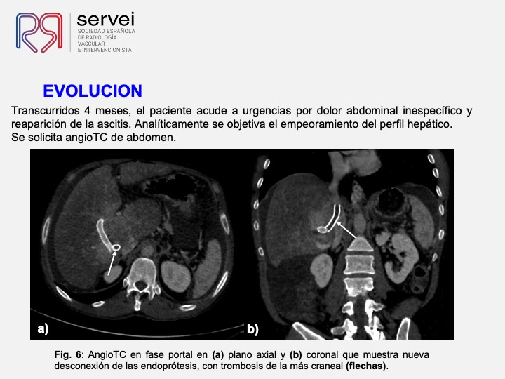 DIPS tecnica gun-sight 08