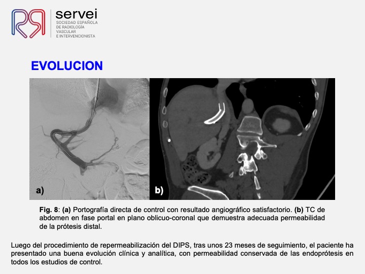 DIPS tecnica gun-sight 10