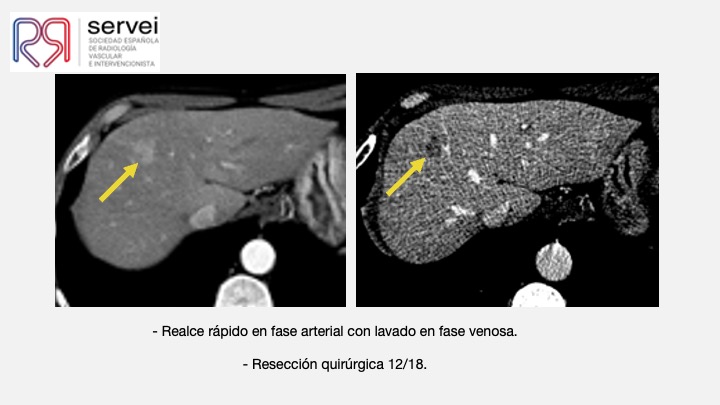Ablacion estereoataxia lesiones hepaticas 03